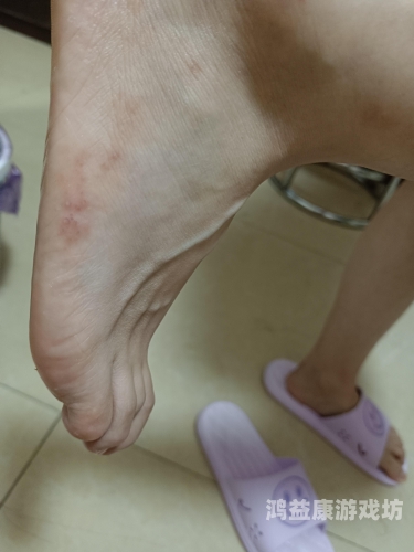 脚底长水泡样异物，奇痒难忍？可能是这些原因导致的儿童脚底长了像水泡一样的东西很痒