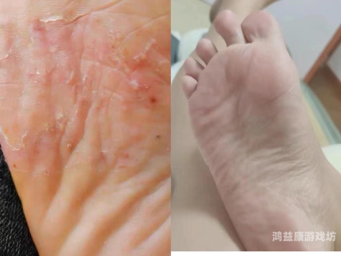 脚底长水泡样异物，奇痒难忍？可能是这些原因导致的儿童脚底长了像水泡一样的东西很痒