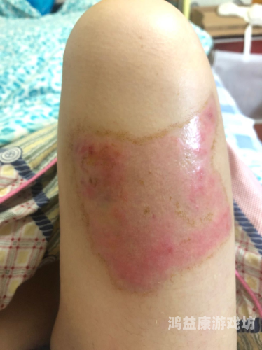 少女花150元文身，清洗费用竟高达76.9万元！背后真相令人震惊洗文身要多少钱