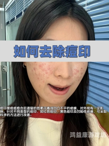 如何有效去除痘痘
